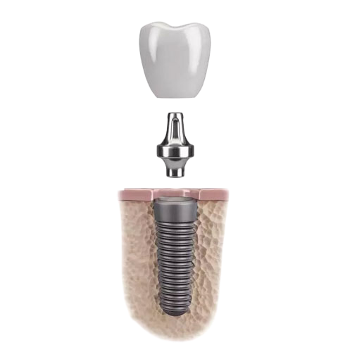 Индивидуальный абатмент