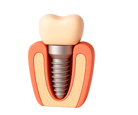 Имплантация зубов
